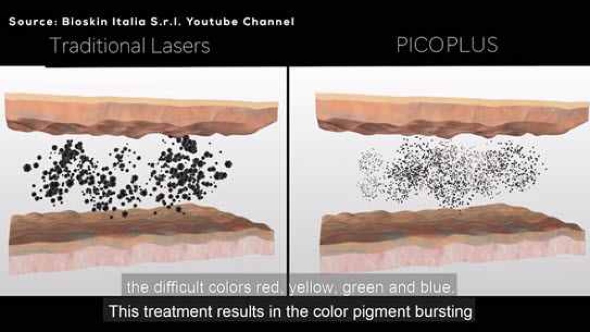 PicoPlus Laser