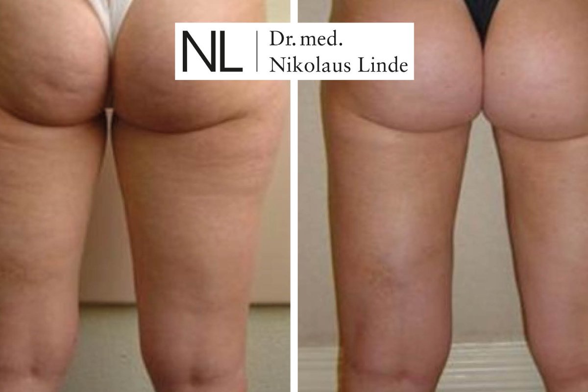 Cellulite vorher/nachher