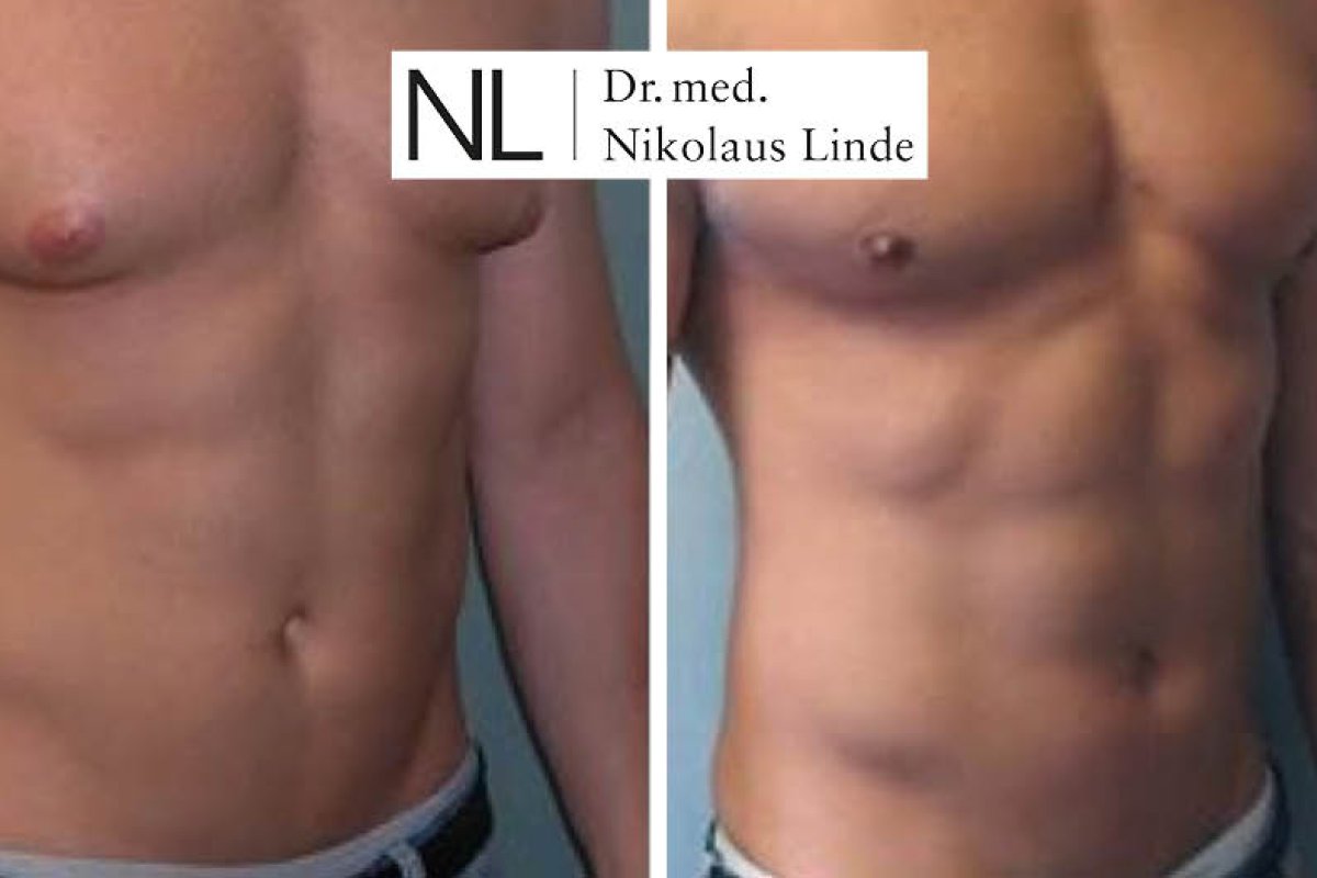 High Definition Liposuction