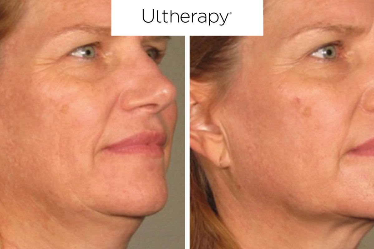 Ultherapy<sup>®</sup>